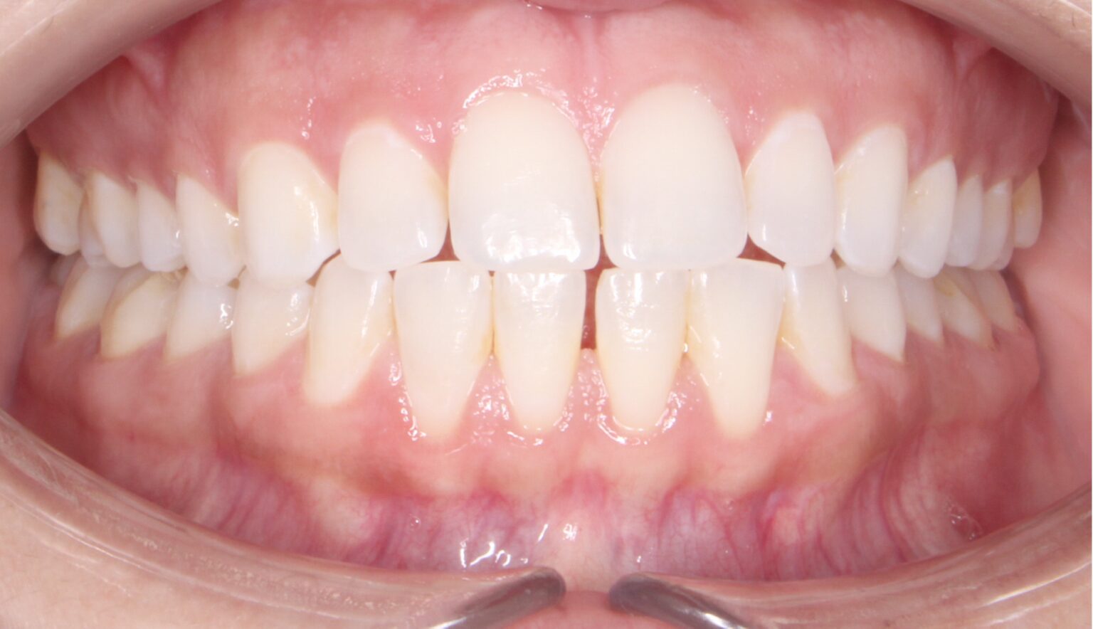 Before and after orthodontic treatment at Alamo Ranch Orthodontics