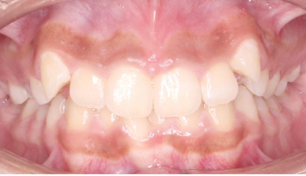 Before and After treatment at Alamo Ranch Orthodontics in San Antonio, TX