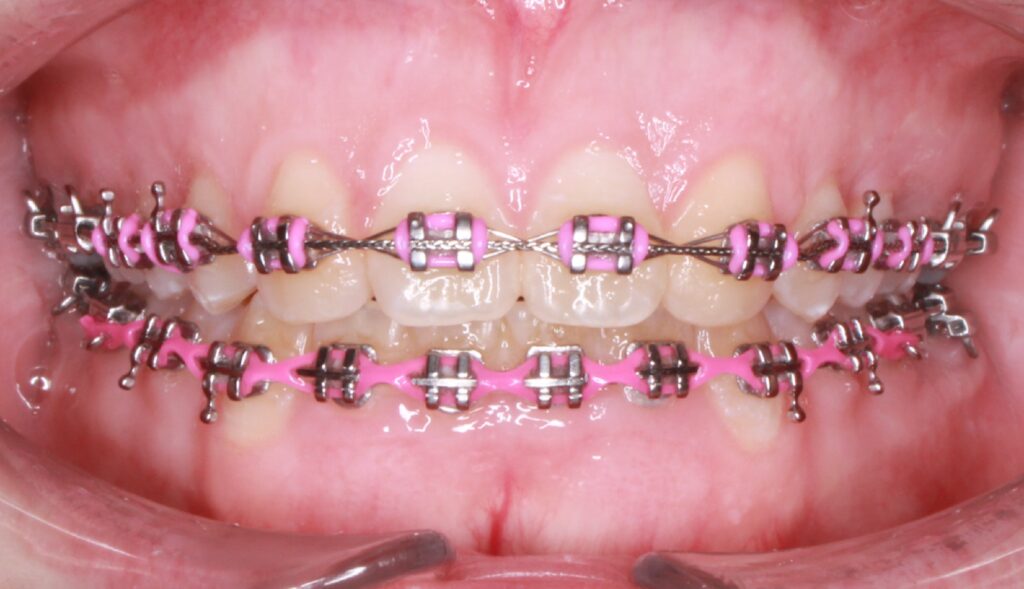 Types of Braces San Antonio TX Alamo Ranch Orthodontics