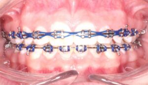 Clear Braces, Ceramic Braces, San Antonio, TX