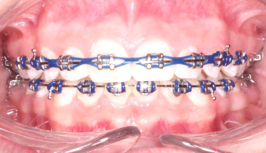Types of Braces San Antonio TX Alamo Ranch Orthodontics