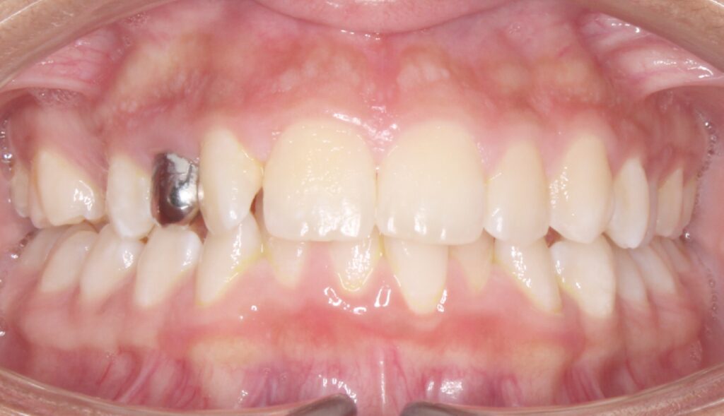 Before and After treatment at Alamo Ranch Orthodontics in San Antonio, TX
